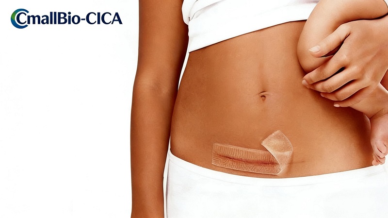 CmallBio Thickened Silicone Scar Patch (CmallBio-CICA) Berkinerja Cemerlang Baru-baru ini, Menstabilkan Posisinya di Tingkat Atas Bidang Penghilang Bekas Luka Silikon Medis